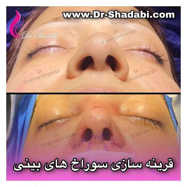 نمونه کار جراحی بینی دکتر شبنم شادابی