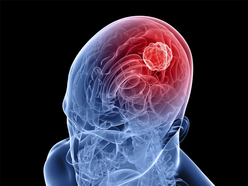 هرآنچه که باید درمورد متاستاز (Brain metastases) مغزی بدانید؟