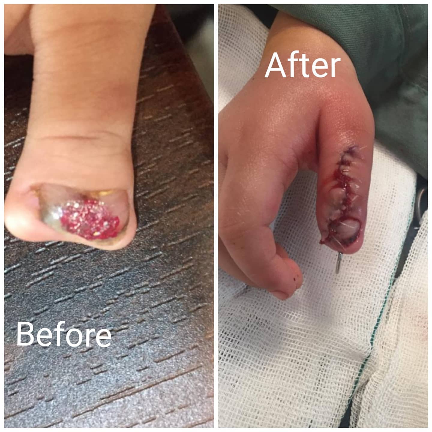 جراحی بازسازی انگشت شصت در کودک هجده ماهه-min