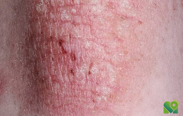 نشانه های اگزما پوست در بدن کدام است؟
