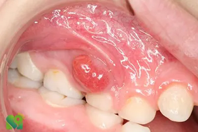 درمان عفونت های دندانی در کودکان