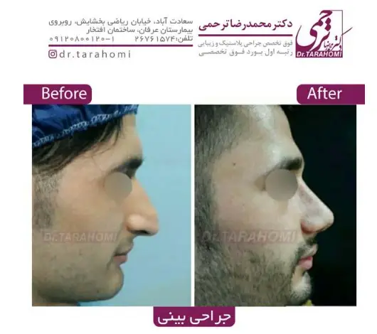 عکس قبل و بعد جراحی زیبایی بینی