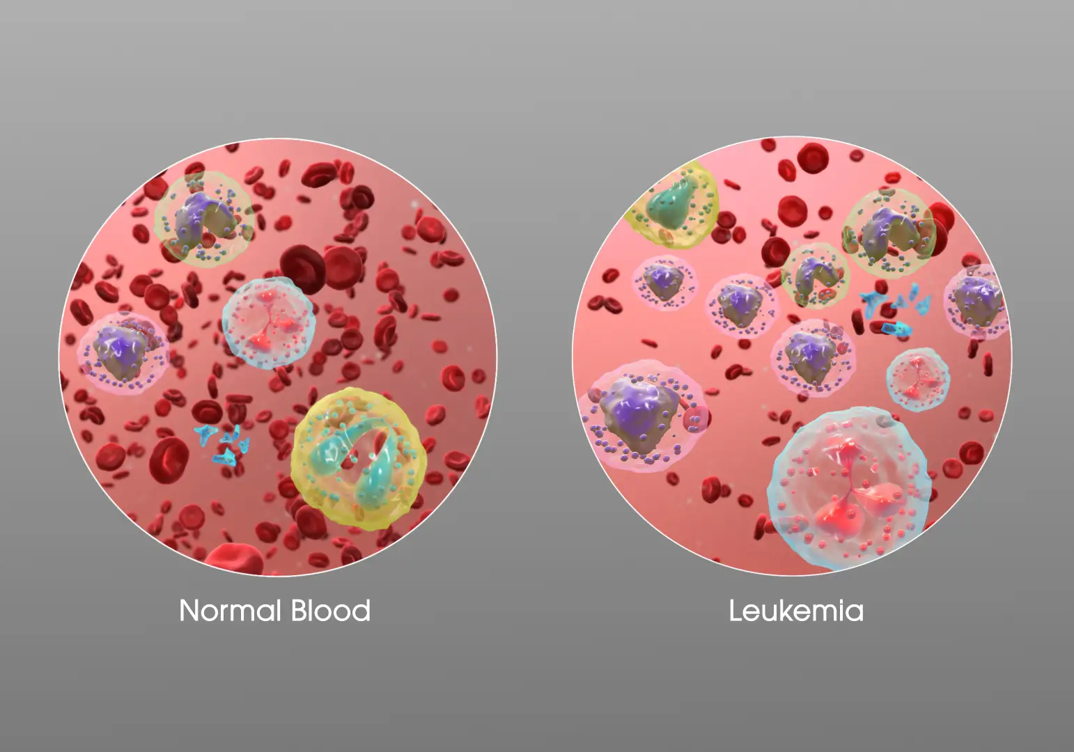 کدام نوع سرطان خون کشنده است